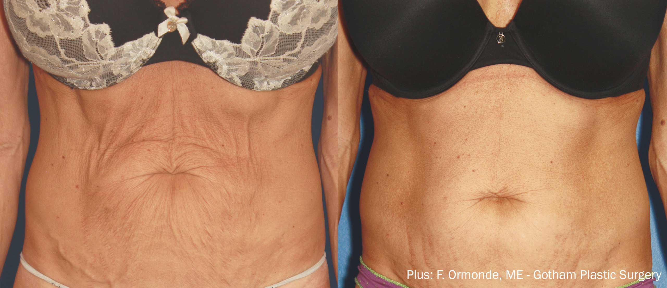 Rf лифтинг живота до и после отзывы Non-invasive Tissue & Skin Remodeling - TechnologyPlus