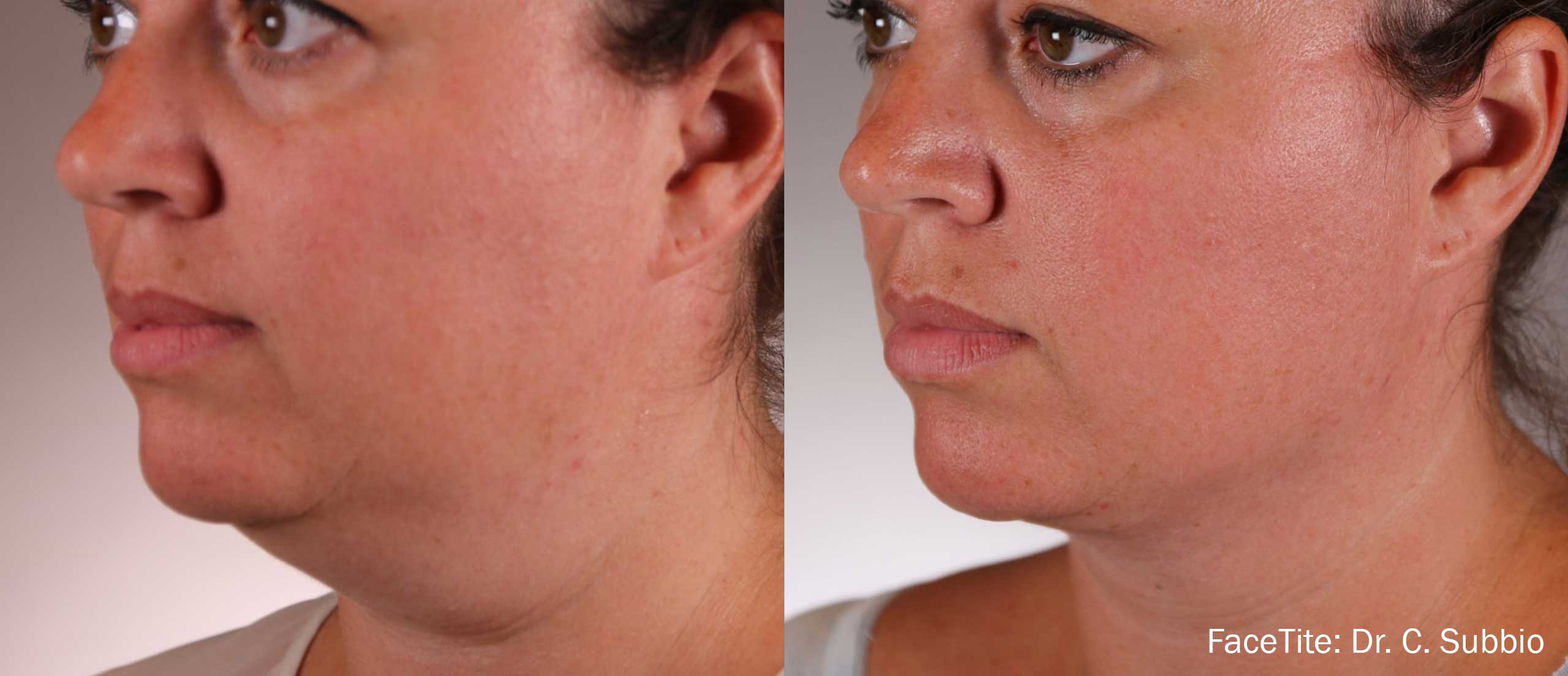 FaceTite treatment provides impressive results in contouring the area under...