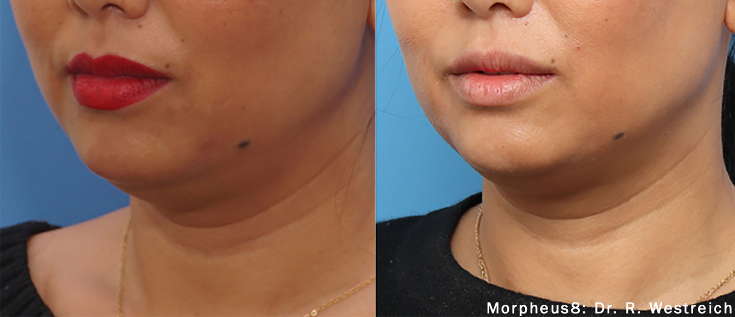  Morpheus8-Jawline---Before-and-After-image