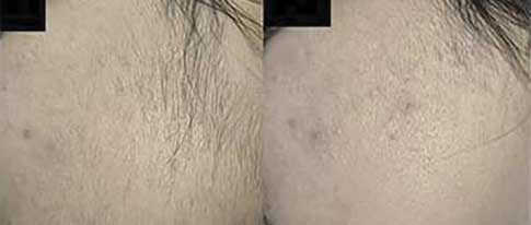 Effective Laser Hair Removal