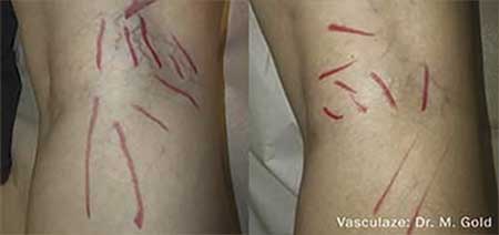 Spider Veins And Vascular Lesions
