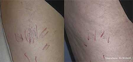Spider Veins And Vascular Lesions