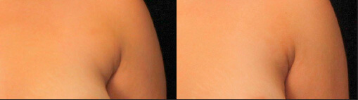 accutite before after photo 1