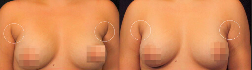 accutite before after photo 2
