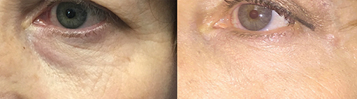 accutite before after photo 1