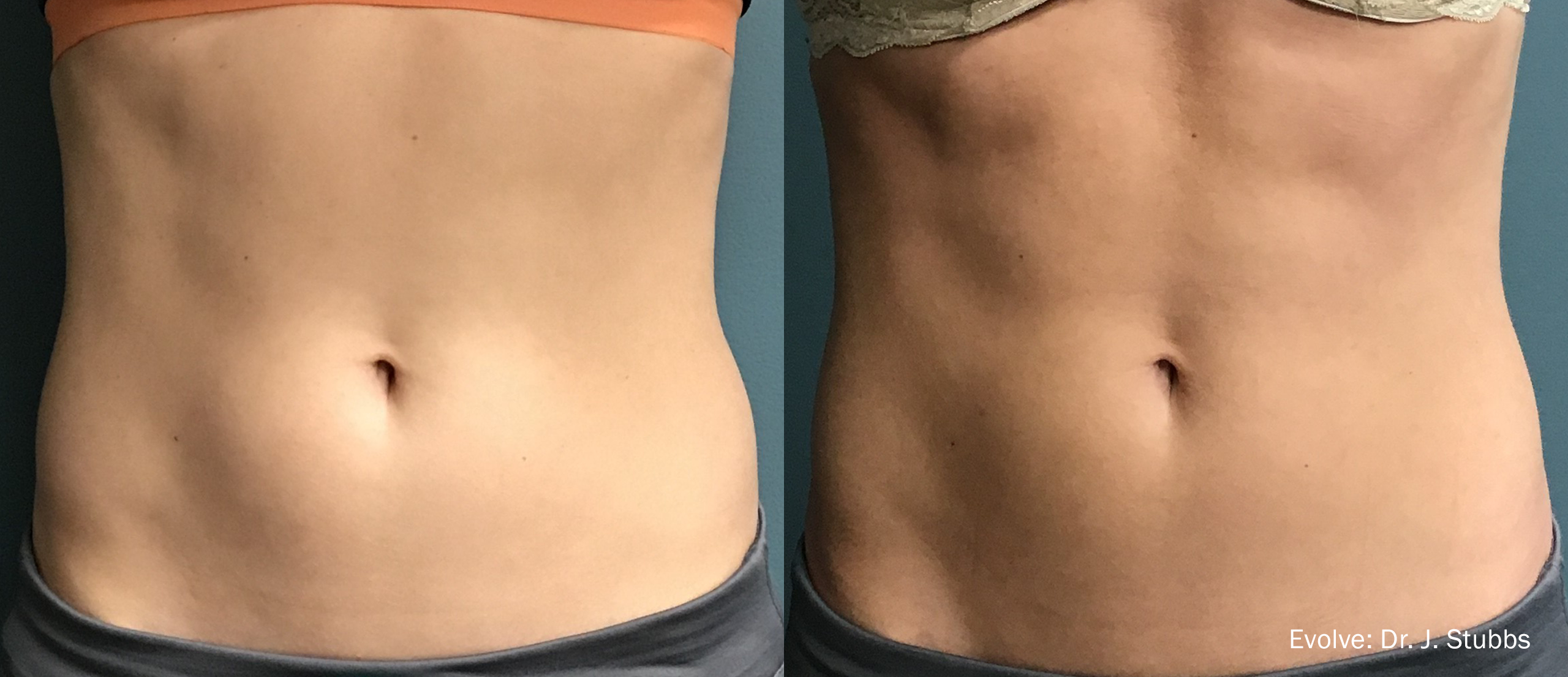 Non Invasive Body Contouring with Evolve, BodyFX & Forma Plus