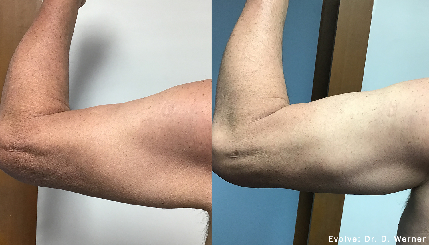  EvolveX Before and After Arms