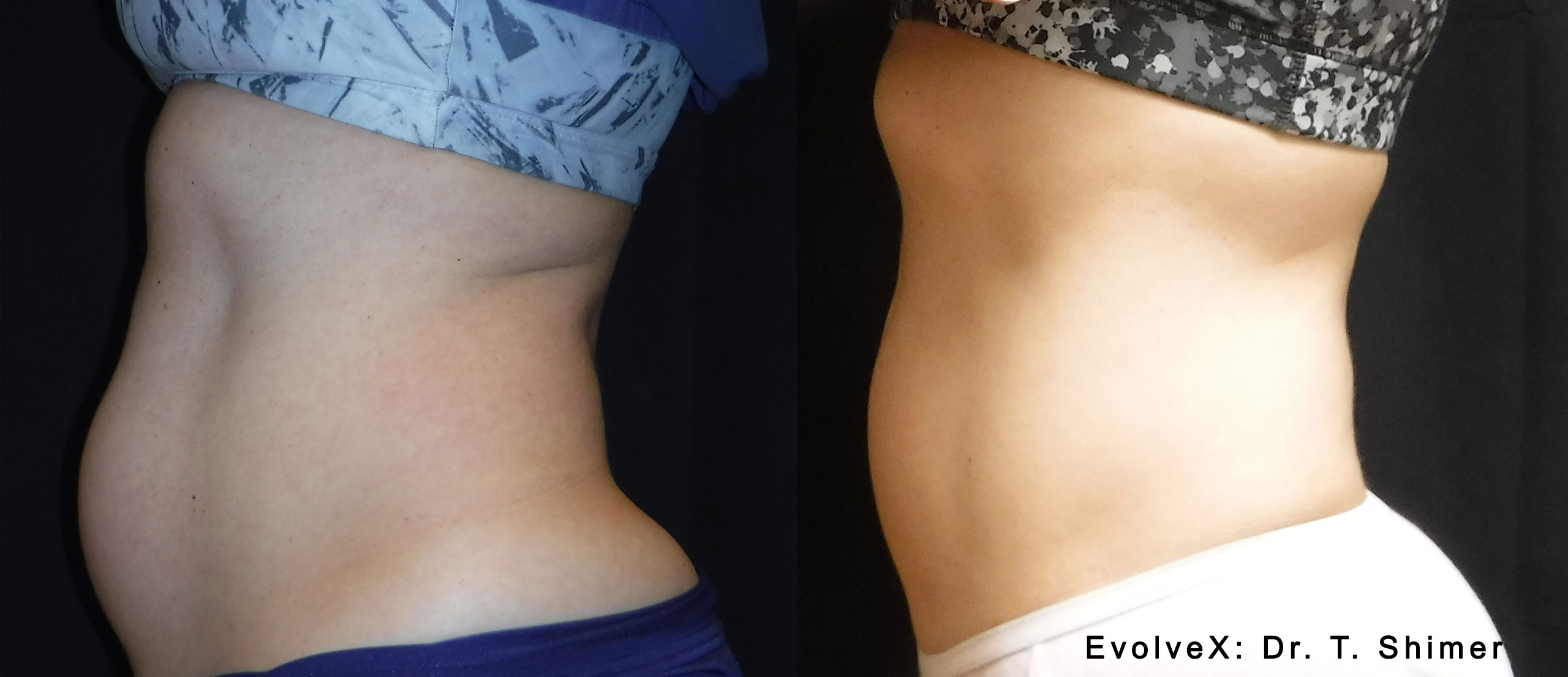  EvolveX-Before-and-After-Abdomen