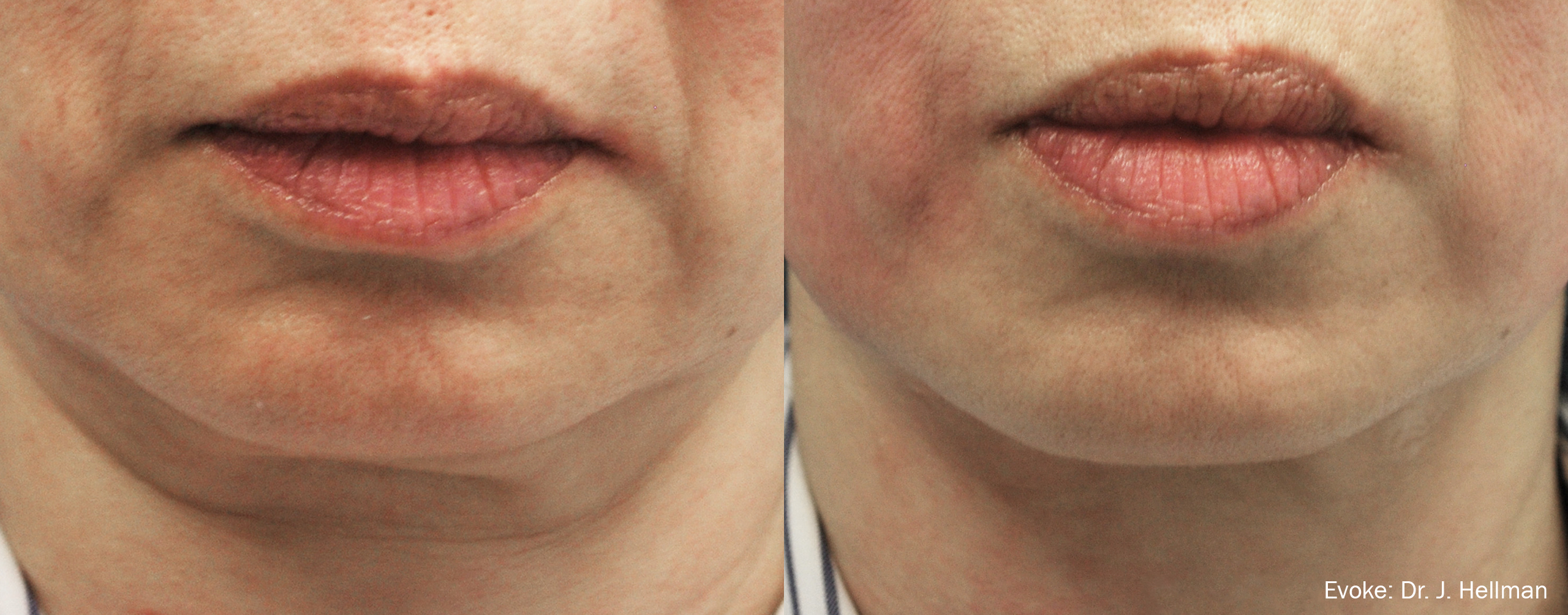  Evoke on Jowls Before and After image