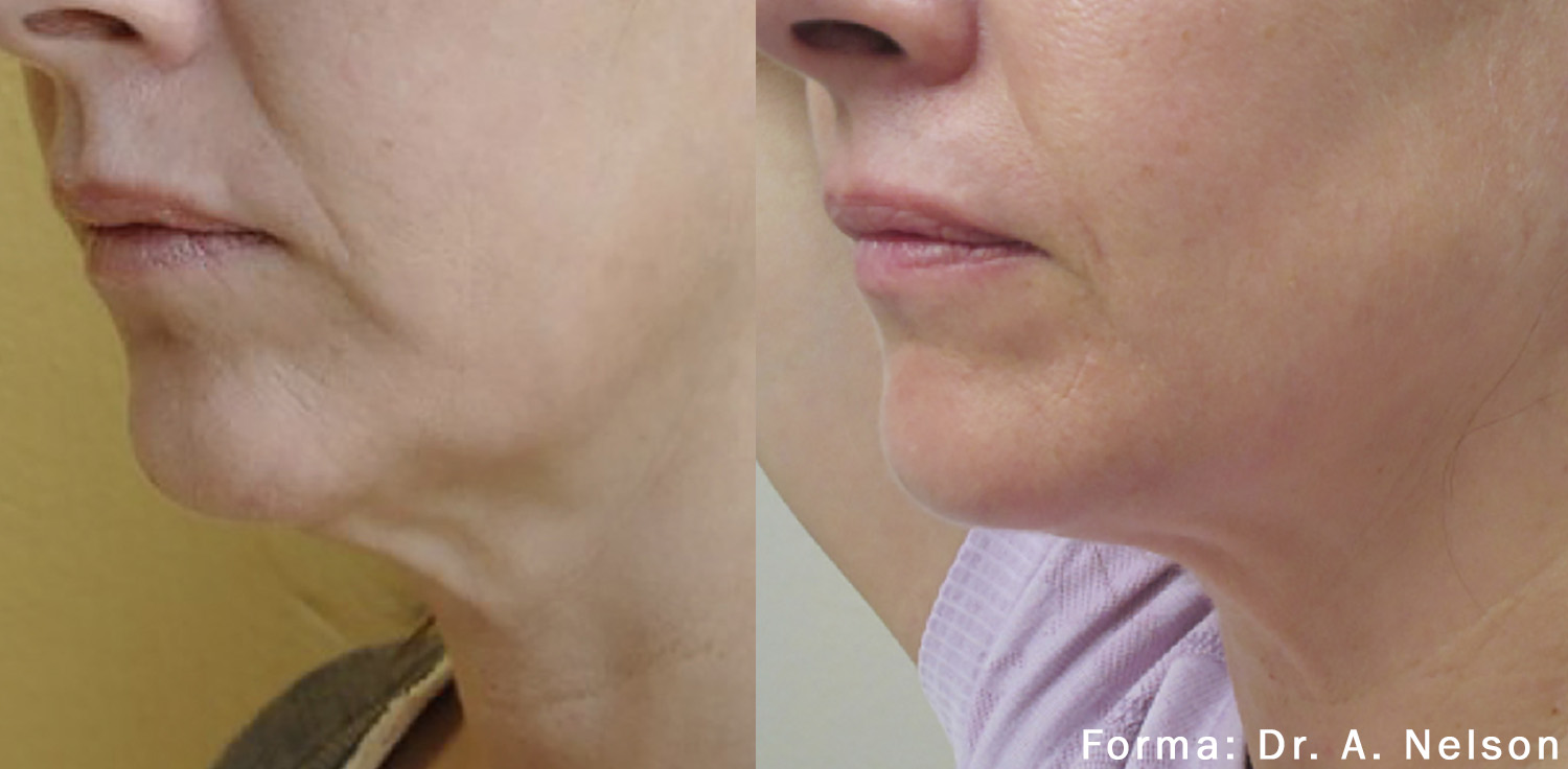 Non Invasive Neck Face Remodeling