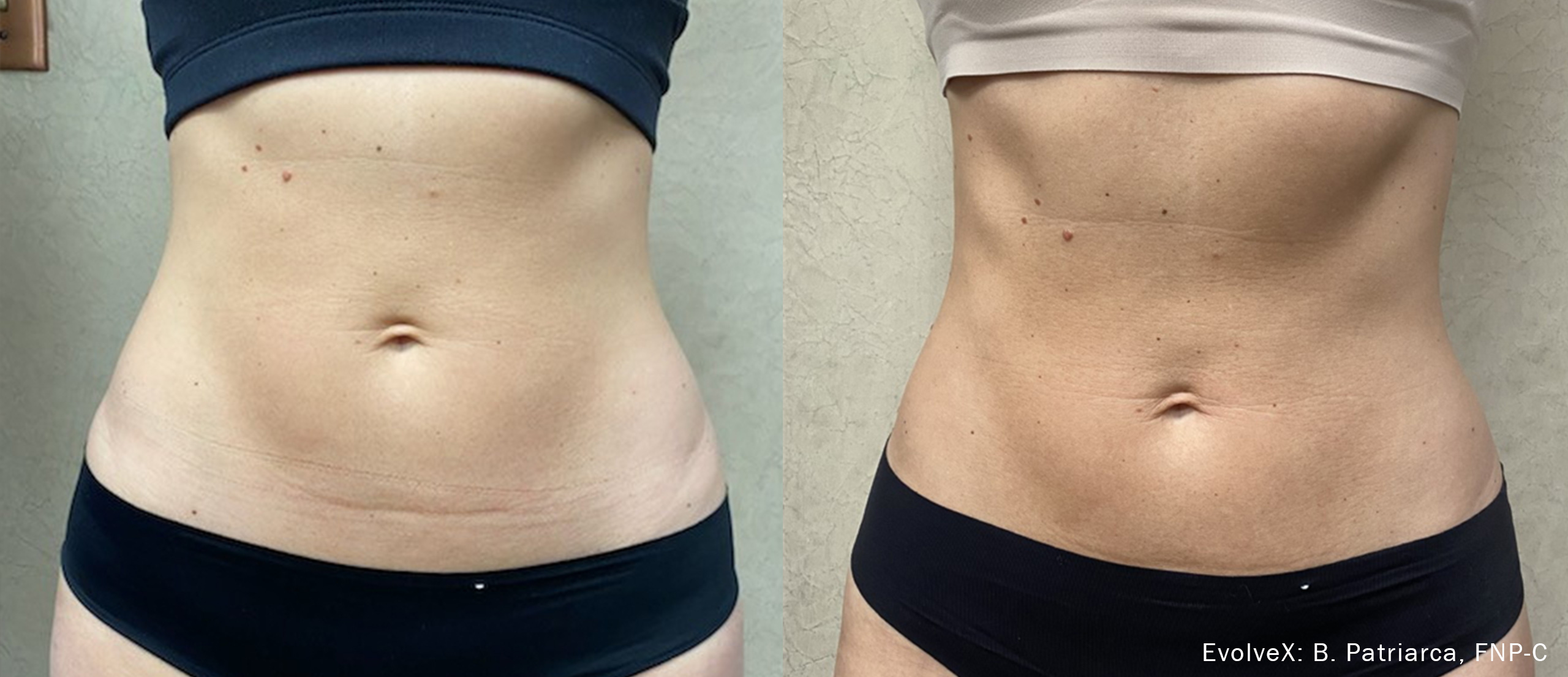  EvolveX Before and After Abs