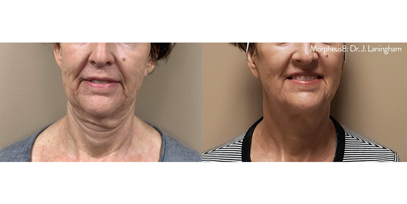  Minimally-Invasive-Face-Treatment-Before-and-After