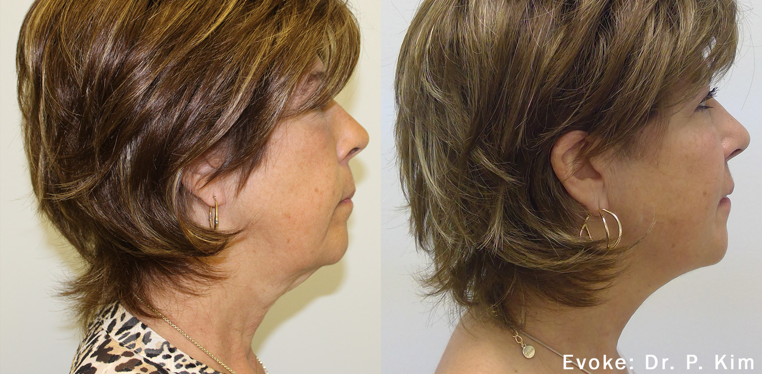 Non Invasive Neck Face Remodeling